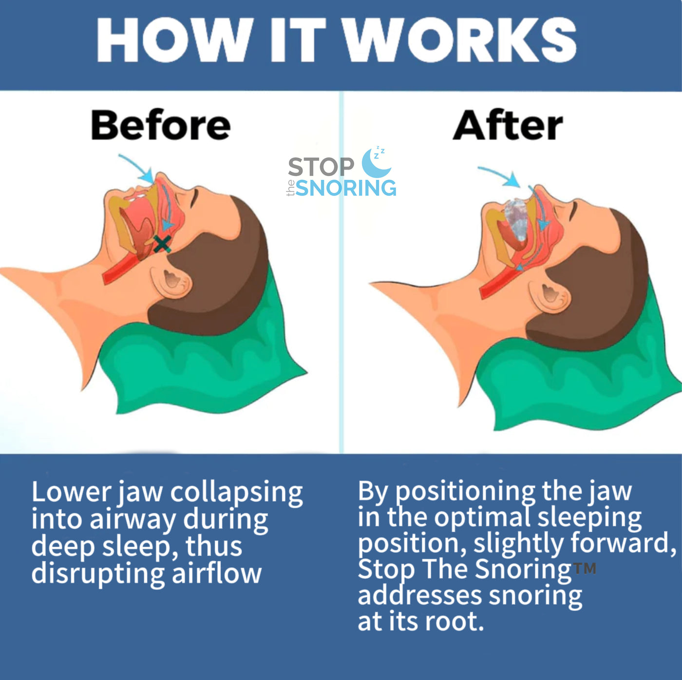 STOP THE SNORING™ - HELPING MILLIONS OF SNORERS & THEIR SLEEP PARTNERS